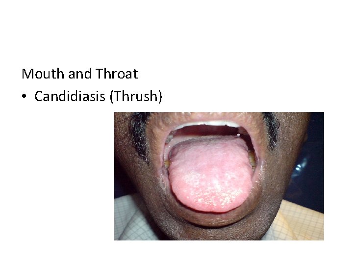 Mouth and Throat • Candidiasis (Thrush) 