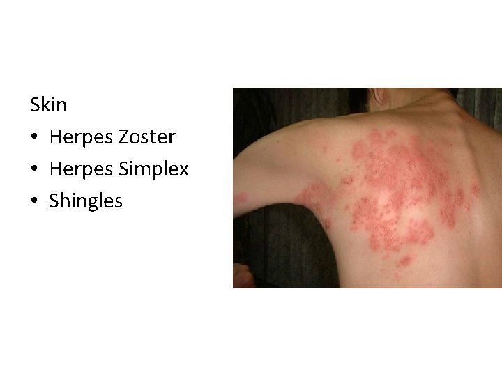 Skin • Herpes Zoster • Herpes Simplex • Shingles 