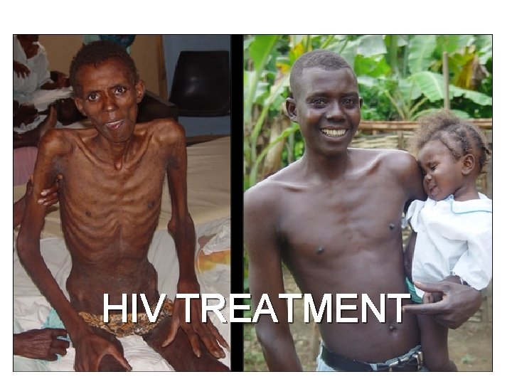 HIV TREATMENT 