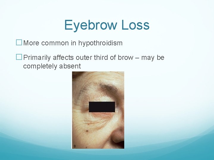 Eyebrow Loss �More common in hypothroidism �Primarily affects outer third of brow – may