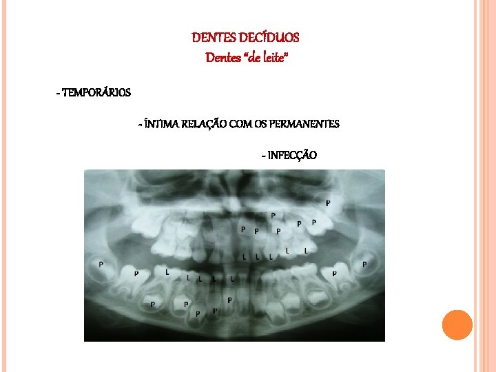 DENTES DECÍDUOS Dentes “de leite” - TEMPORÁRIOS - ÍNTIMA RELAÇÃO COM OS PERMANENTES -