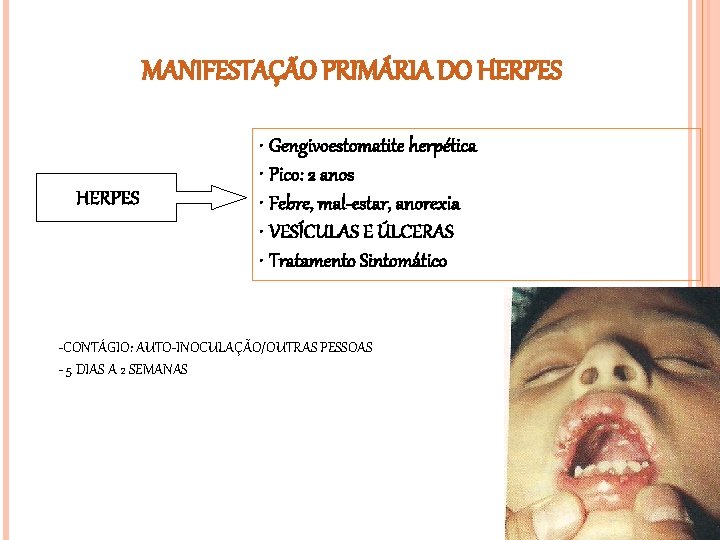 MANIFESTAÇÃO PRIMÁRIA DO HERPES • Gengivoestomatite herpética • Pico: 2 anos • Febre, mal-estar,