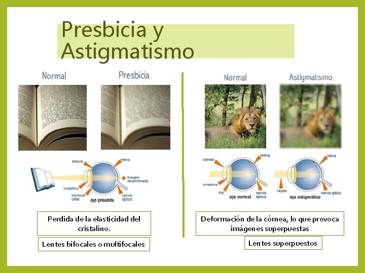 Presbicia y Astigmatismo Perdida de la elasticidad del cristalino. Lentes bifocales o multifocales Deformación