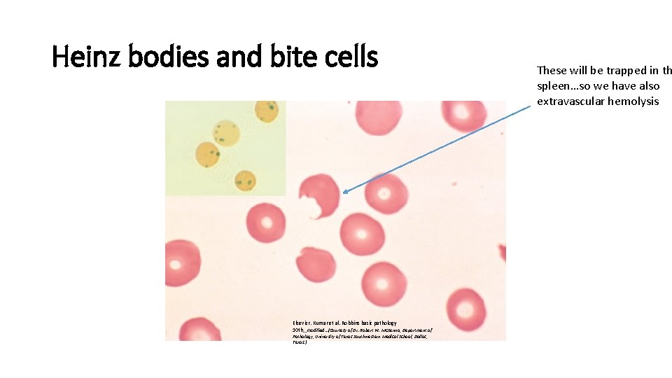Heinz bodies and bite cells Elsevier. Kumar et al. Robbins basic pathology 10 th,