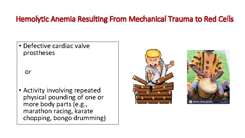 Hemolytic Anemia Resulting From Mechanical Trauma to Red Cells • Defective cardiac valve prostheses