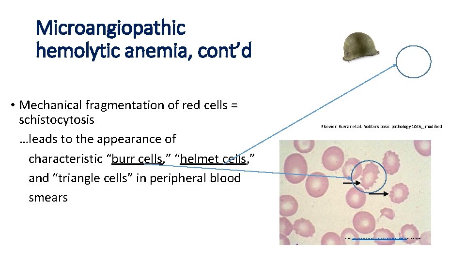 Microangiopathic hemolytic anemia, cont’d • Mechanical fragmentation of red cells = schistocytosis …leads to