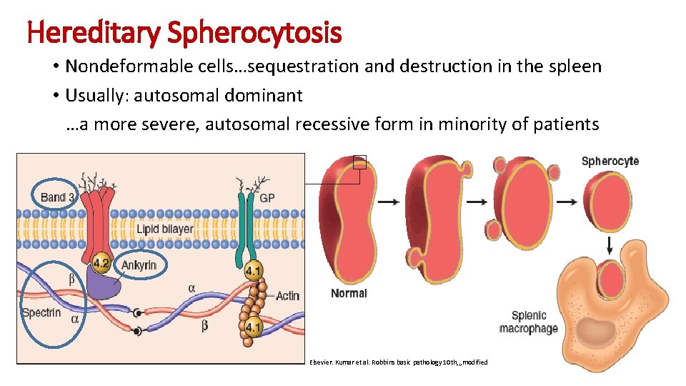 Hereditary Spherocytosis • Nondeformable cells…sequestration and destruction in the spleen • Usually: autosomal dominant