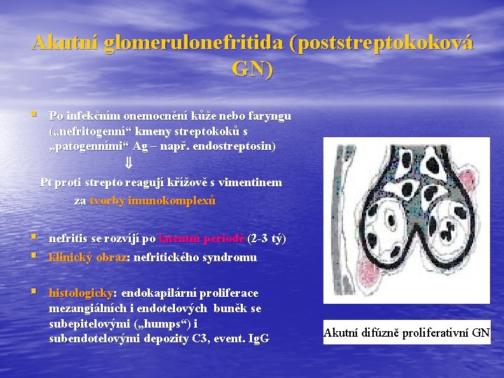 Akutní glomerulonefritida (poststreptokoková GN) § Po infekčním onemocnění kůže nebo faryngu („nefritogenní“ kmeny streptokoků