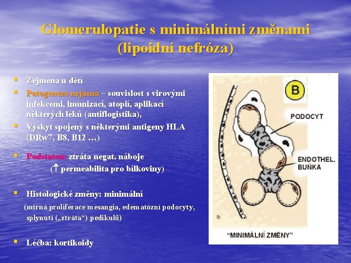 Glomerulopatie s minimálními změnami (lipoidní nefróza) § Zejména u dětí § Patogeneze nejasná –