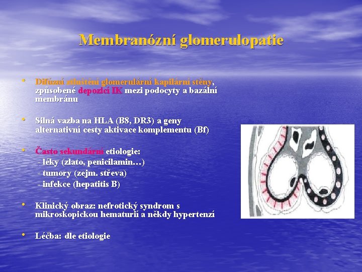 Membranózní glomerulopatie • Difúzní ztluštění glomerulární kapilární stěny, způsobené depozicí IK mezi podocyty a