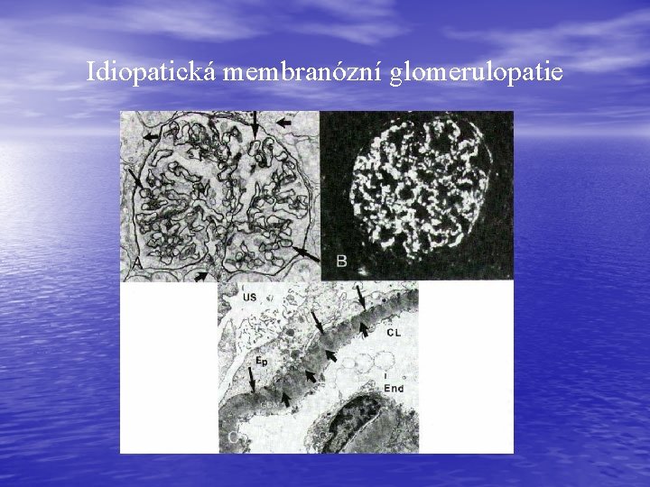 Idiopatická membranózní glomerulopatie Idiopatická membranózní glomerulopatie