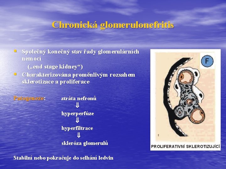 Chronická glomerulonefritis § Společný konečný stav řady glomerulárních § nemocí („end stage kidney“) Charakterizována