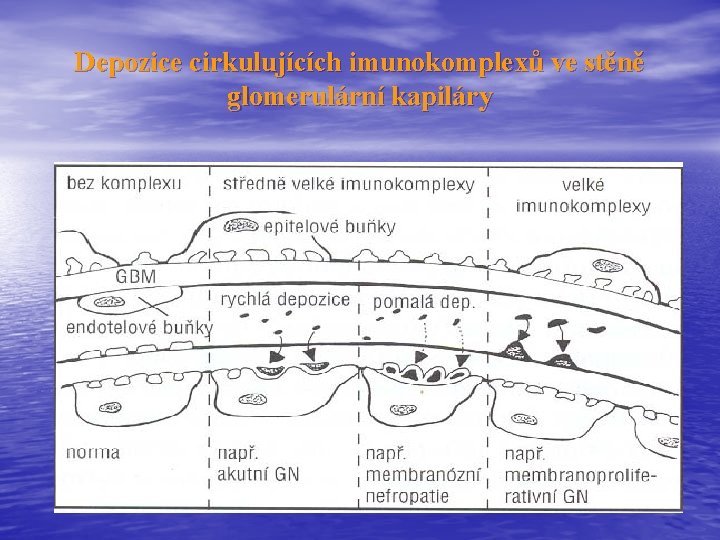 Depozice cirkulujících imunokomplexů ve stěně glomerulární kapiláry 