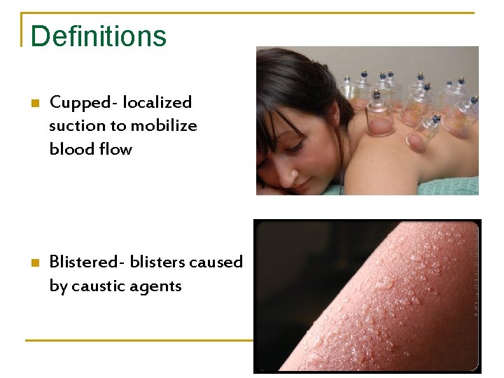 Definitions n Cupped- localized suction to mobilize blood flow n Blistered- blisters caused by