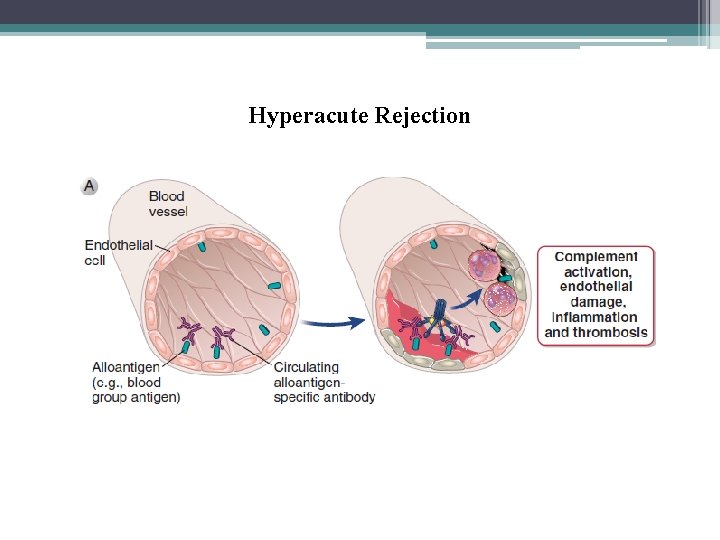 Hyperacute Rejection 