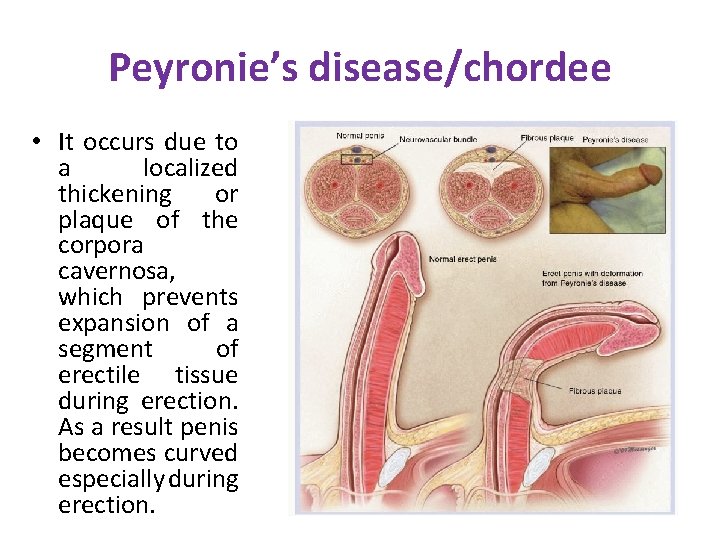 Peyronie’s disease/chordee • It occurs due to a localized thickening or plaque of the Peyronie’s disease/chordee • It occurs due to a localized thickening or plaque of the
