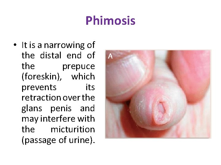 Phimosis • It is a narrowing of the distal end of the prepuce (foreskin), Phimosis • It is a narrowing of the distal end of the prepuce (foreskin),