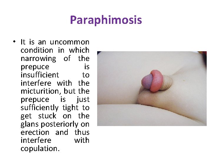 Paraphimosis • It is an uncommon condition in which narrowing of the prepuce is Paraphimosis • It is an uncommon condition in which narrowing of the prepuce is