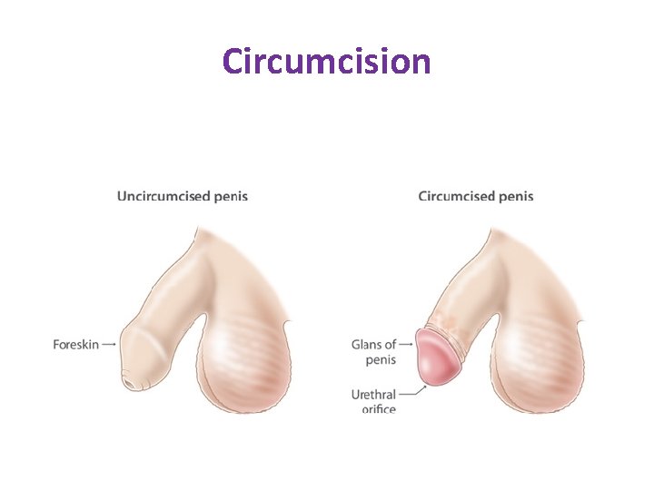 Circumcision Circumcision