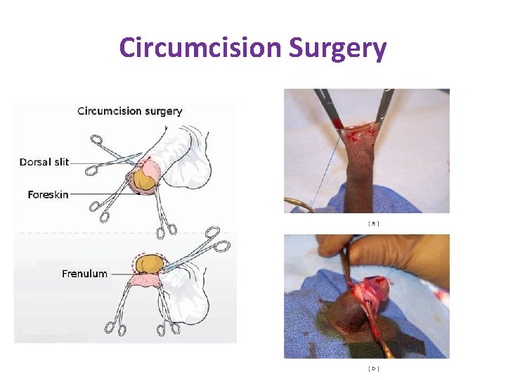 Circumcision Surgery Circumcision Surgery