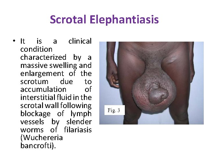 Scrotal Elephantiasis • It is a clinical condition characterized by a massive swelling and Scrotal Elephantiasis • It is a clinical condition characterized by a massive swelling and
