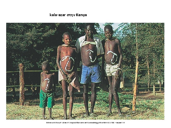 kala-azar στην Kenya 