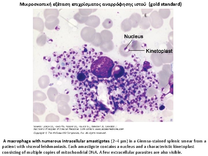 Μικροσκοπική εξέταση επιχρίσματος αναρρόφησης ιστού (gold standard) A macrophage with numerous intracellular amastigotes (2–