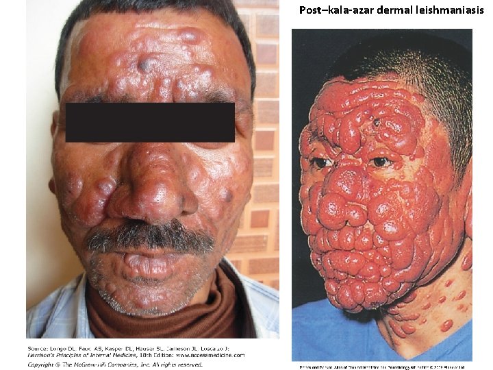 Post–kala-azar dermal leishmaniasis 