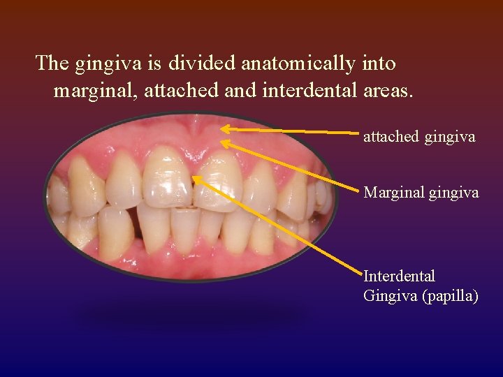 The gingiva is divided anatomically into marginal, attached and interdental areas. attached gingiva Marginal