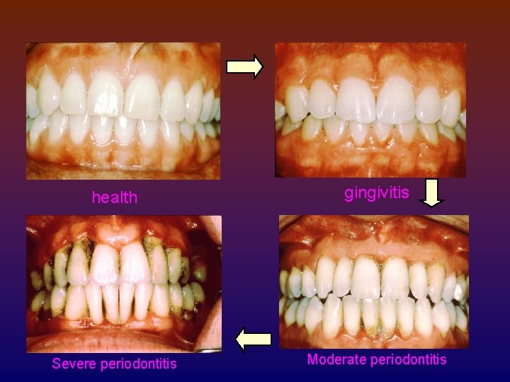 health gingivitis Severe periodontitis Moderate periodontitis 