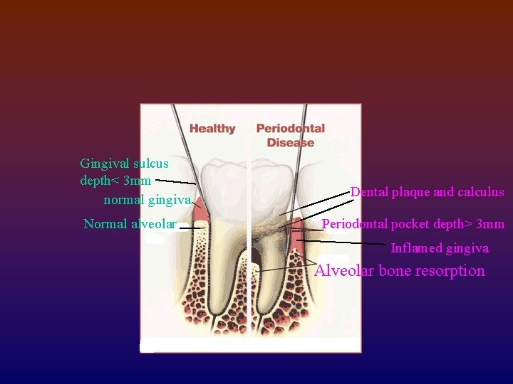 Gingival sulcus depth< 3 mm normal gingiva Normal alveolar Dental plaque and calculus Periodontal