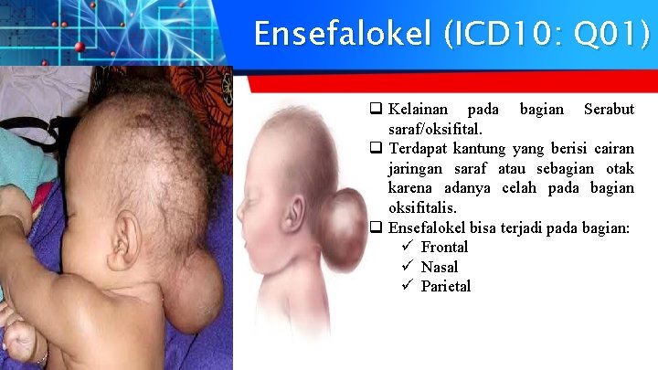 Ensefalokel (ICD 10: Q 01) q Kelainan pada bagian Serabut saraf/oksifital. q Terdapat kantung