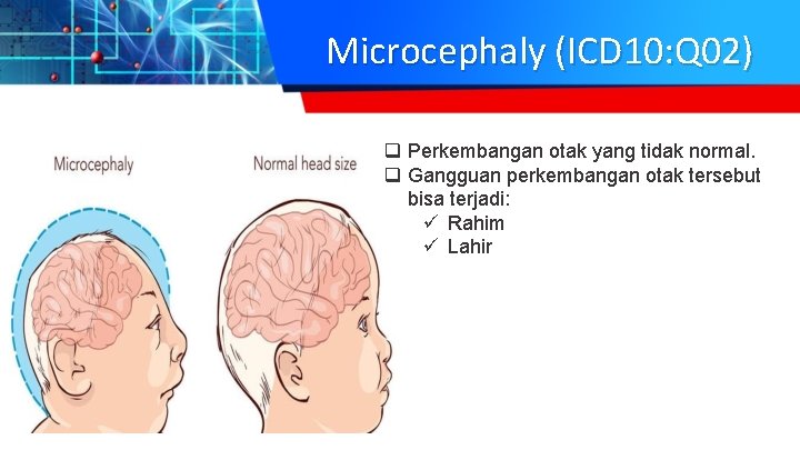 Microcephaly (ICD 10: Q 02) q Perkembangan otak yang tidak normal. q Gangguan perkembangan