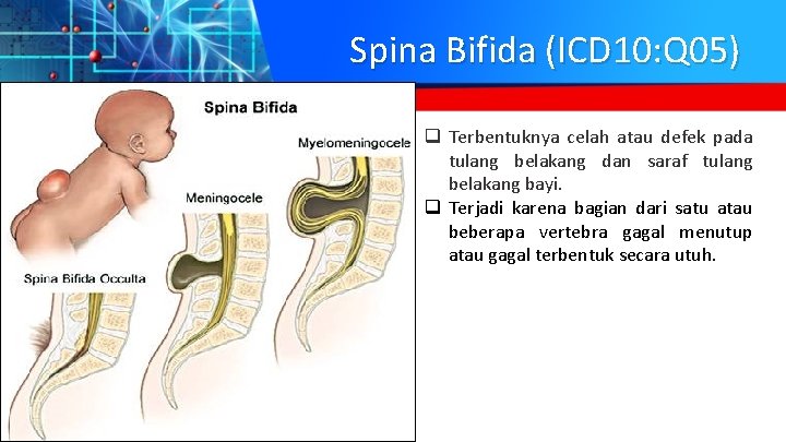 Spina Bifida (ICD 10: Q 05) q Terbentuknya celah atau defek pada tulang belakang