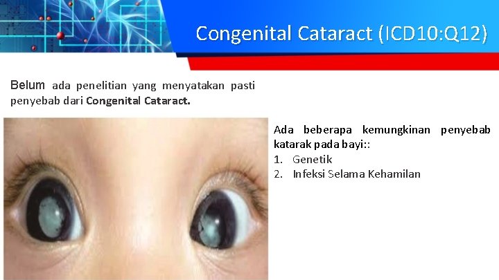 Congenital Cataract (ICD 10: Q 12) Belum ada penelitian yang menyatakan pasti penyebab dari