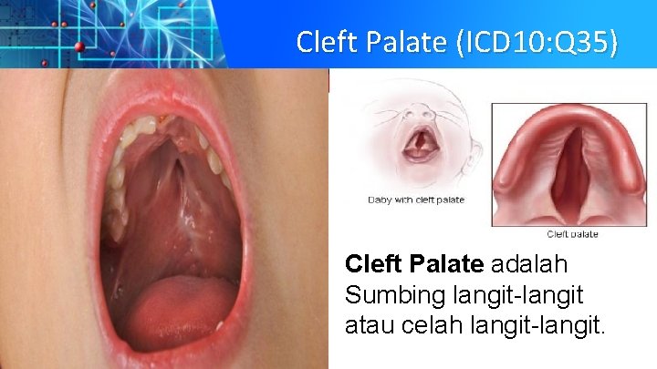 Cleft Palate (ICD 10: Q 35) Cleft Palate adalah Sumbing langit-langit atau celah langit-langit.