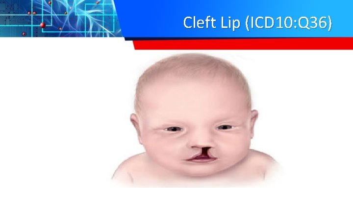 Cleft Lip (ICD 10: Q 36) 