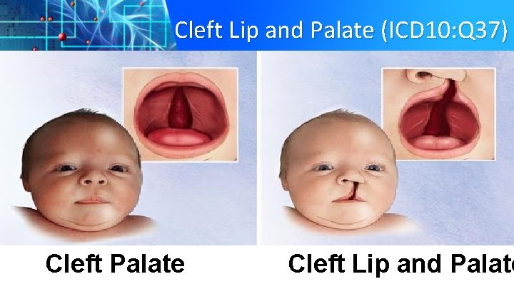 Cleft Lip and Palate (ICD 10: Q 37) Cleft Palate Cleft Lip and Palate