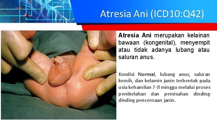 Atresia Ani (ICD 10: Q 42) Atresia Ani merupakan kelainan bawaan (kongenital), menyempit atau