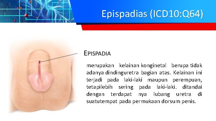 Epispadias (ICD 10: Q 64) merupakan kelainan konginetal berupa tidak adanya dindinguretra bagian atas.