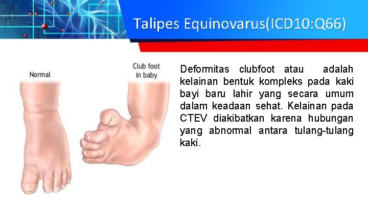 Talipes Equinovarus(ICD 10: Q 66) Deformitas clubfoot atau adalah kelainan bentuk kompleks pada kaki