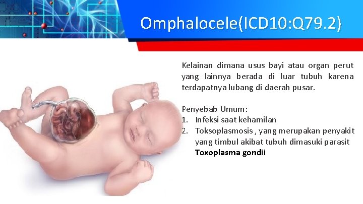 Omphalocele(ICD 10: Q 79. 2) Kelainan dimana usus bayi atau organ perut yang lainnya