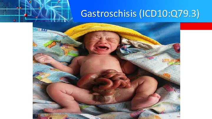 Gastroschisis (ICD 10: Q 79. 3) 