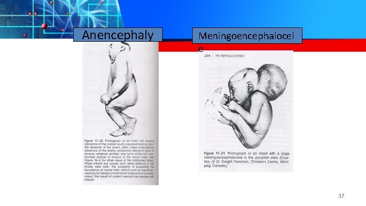 Anencephaly Meningoencephalocel e 37 