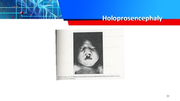 Holoprosencephaly 38 