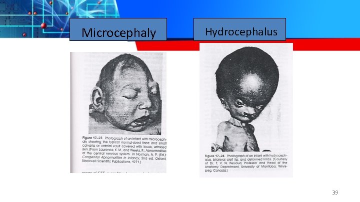 Microcephaly Hydrocephalus 39 