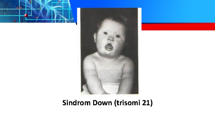 Sindrom Down (trisomi 21) 