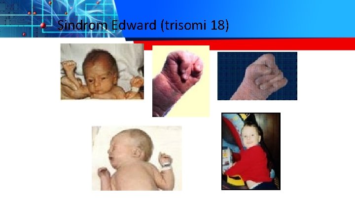 Sindrom Edward (trisomi 18) 