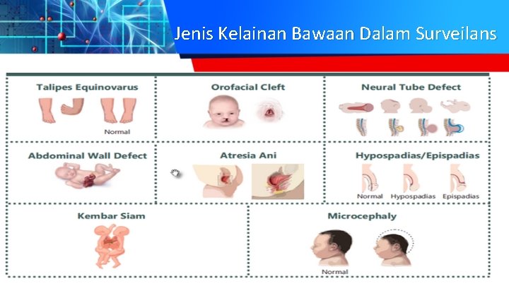 Jenis Kelainan Bawaan Dalam Surveilans 