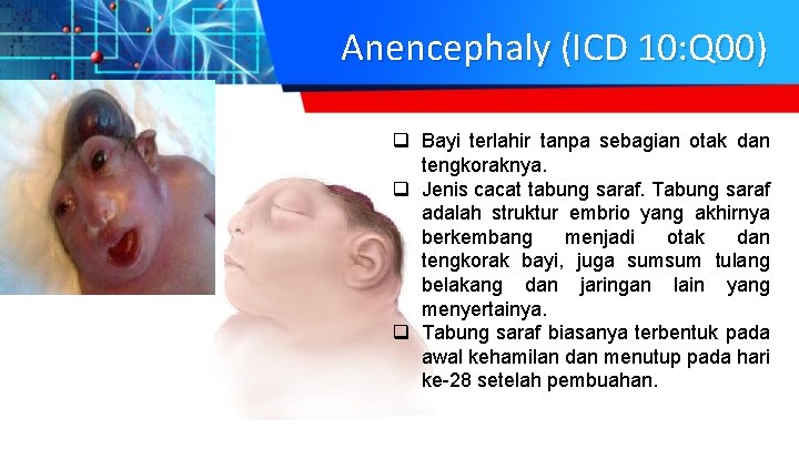 Anencephaly (ICD 10: Q 00) q Bayi terlahir tanpa sebagian otak dan tengkoraknya. q